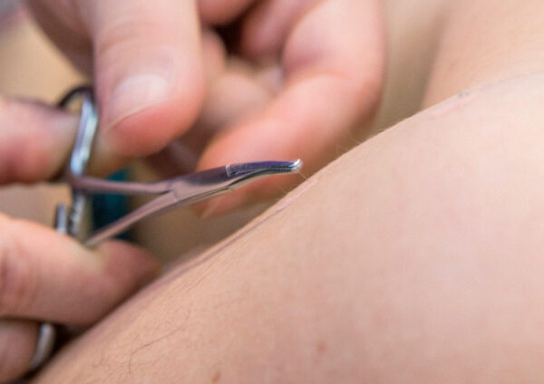 Método Hinaishin, agujas intradérmicas contra el dolor y puntos gatillo acupuntura Trigger