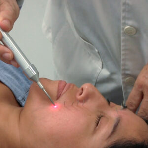 Lifting facial: Acupuntura, electropuntura y laserpuntura